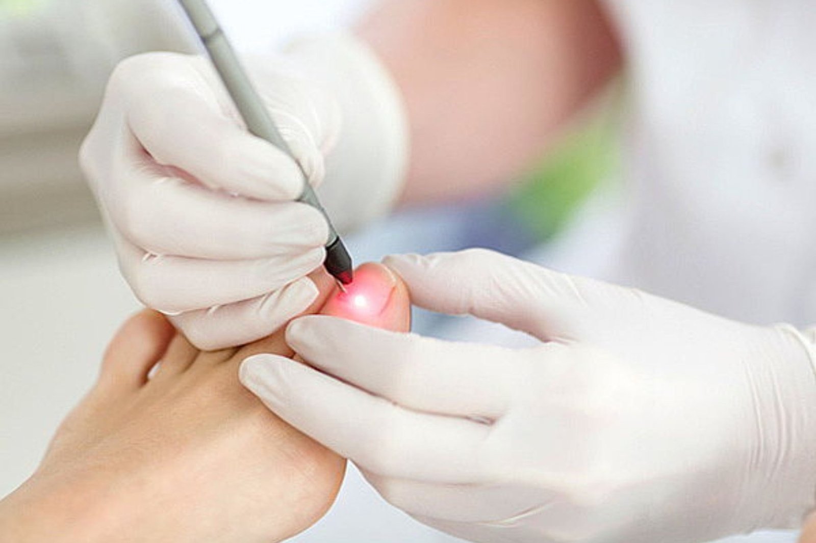 Laser podológico para fungos nas unhas em Queluz com cuidado especializado