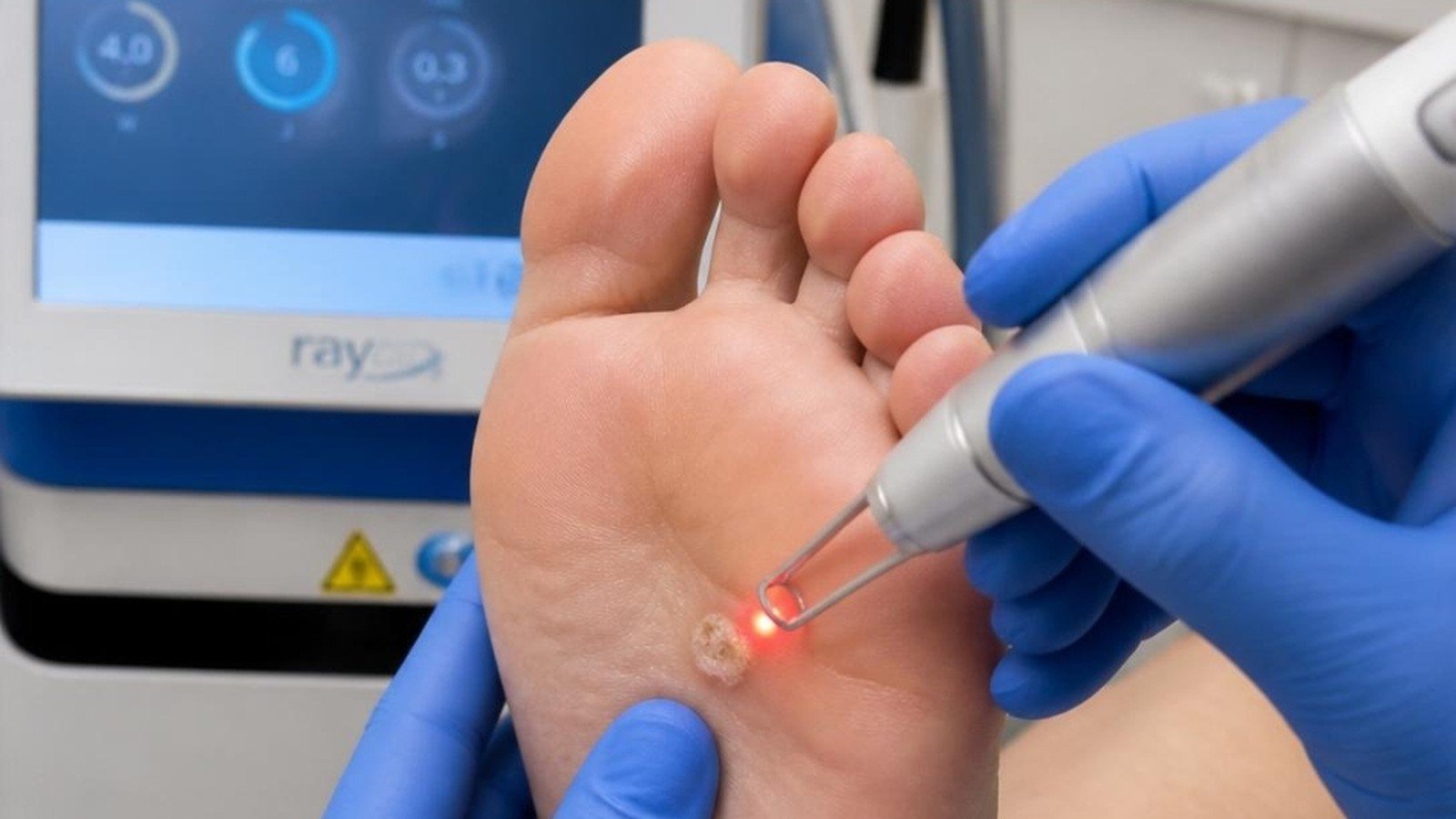 Avaliação e acompanhamento de uma verruga plantar no pé